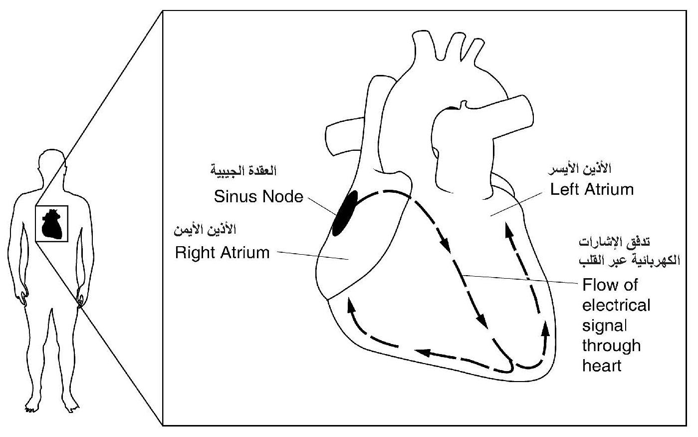 Atrial_Fibrillation